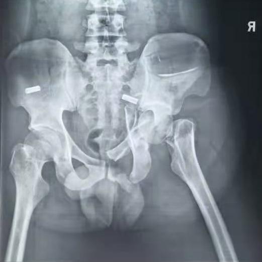 复杂骨盆骨折伴股骨颈骨折手术入路选择