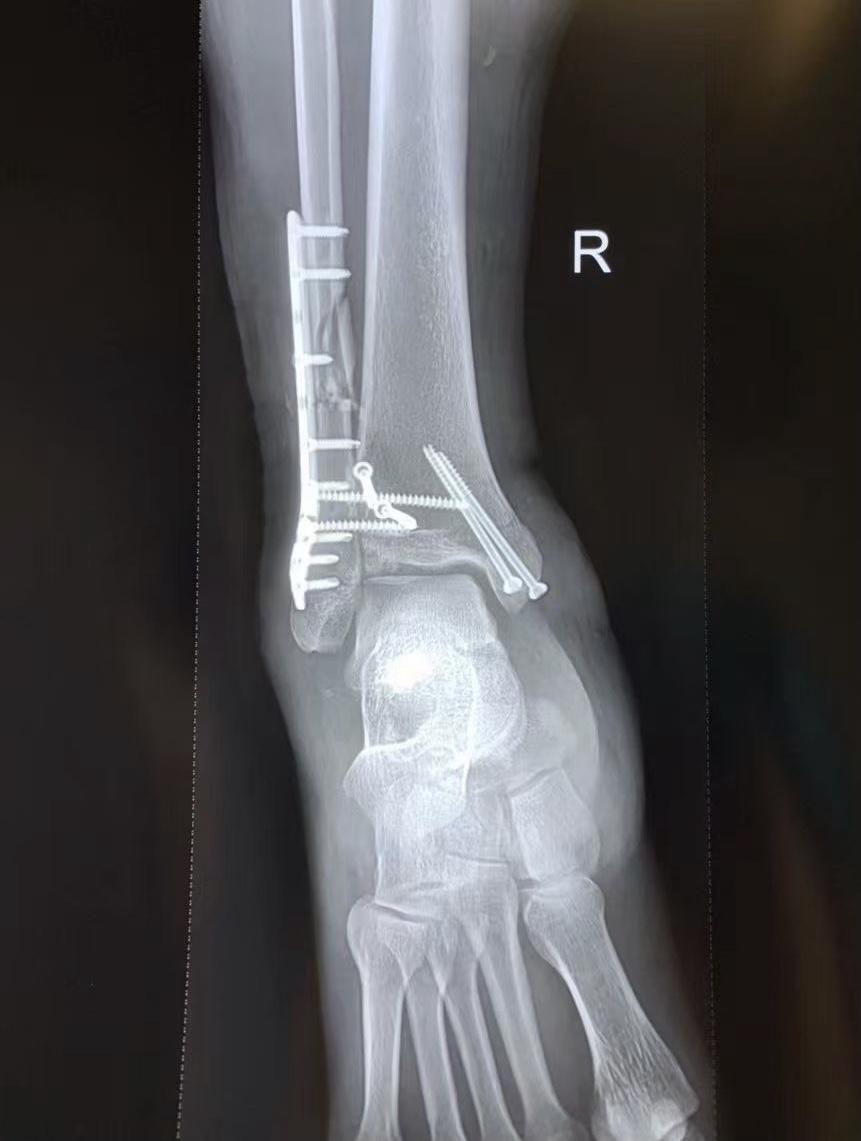 一例特殊的踝关节骨折劈木机骨折手术分享