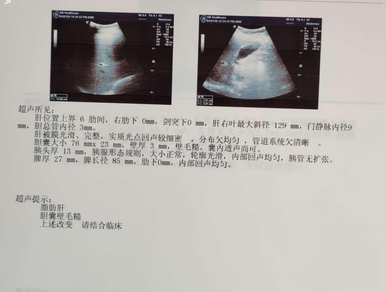 于当地医院检查泌尿系彩超提示:右肾积水,左肾囊肿;泌尿系ct回报:左肾