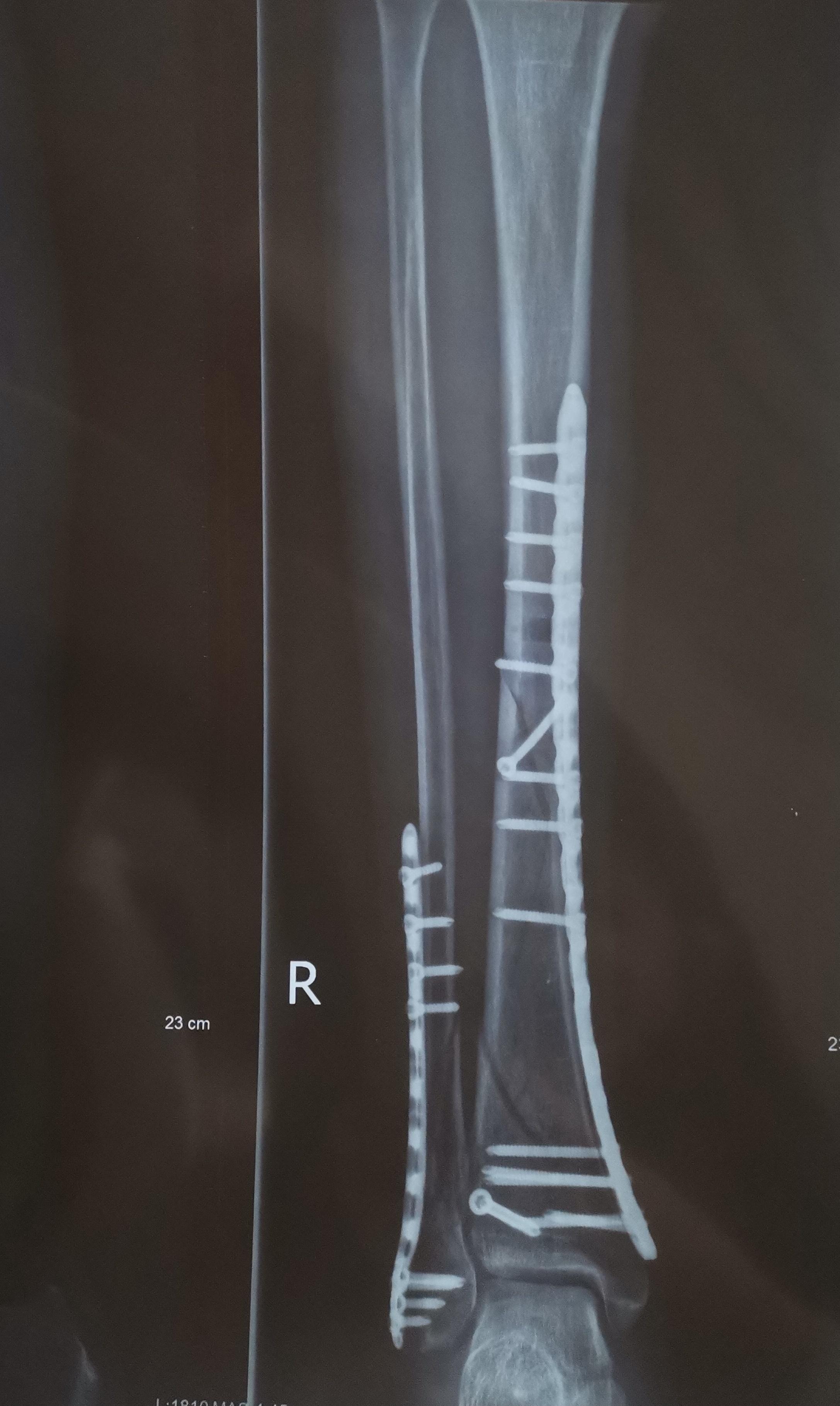 胫骨骨折伴踝关节骨折手术分享