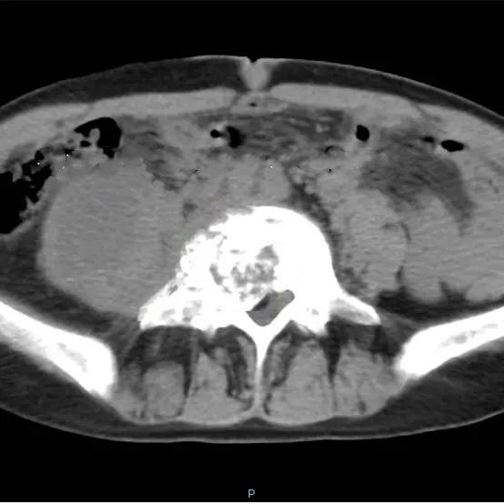 腰4,5椎体结核伴右侧腰大肌寒性脓肿手术分享