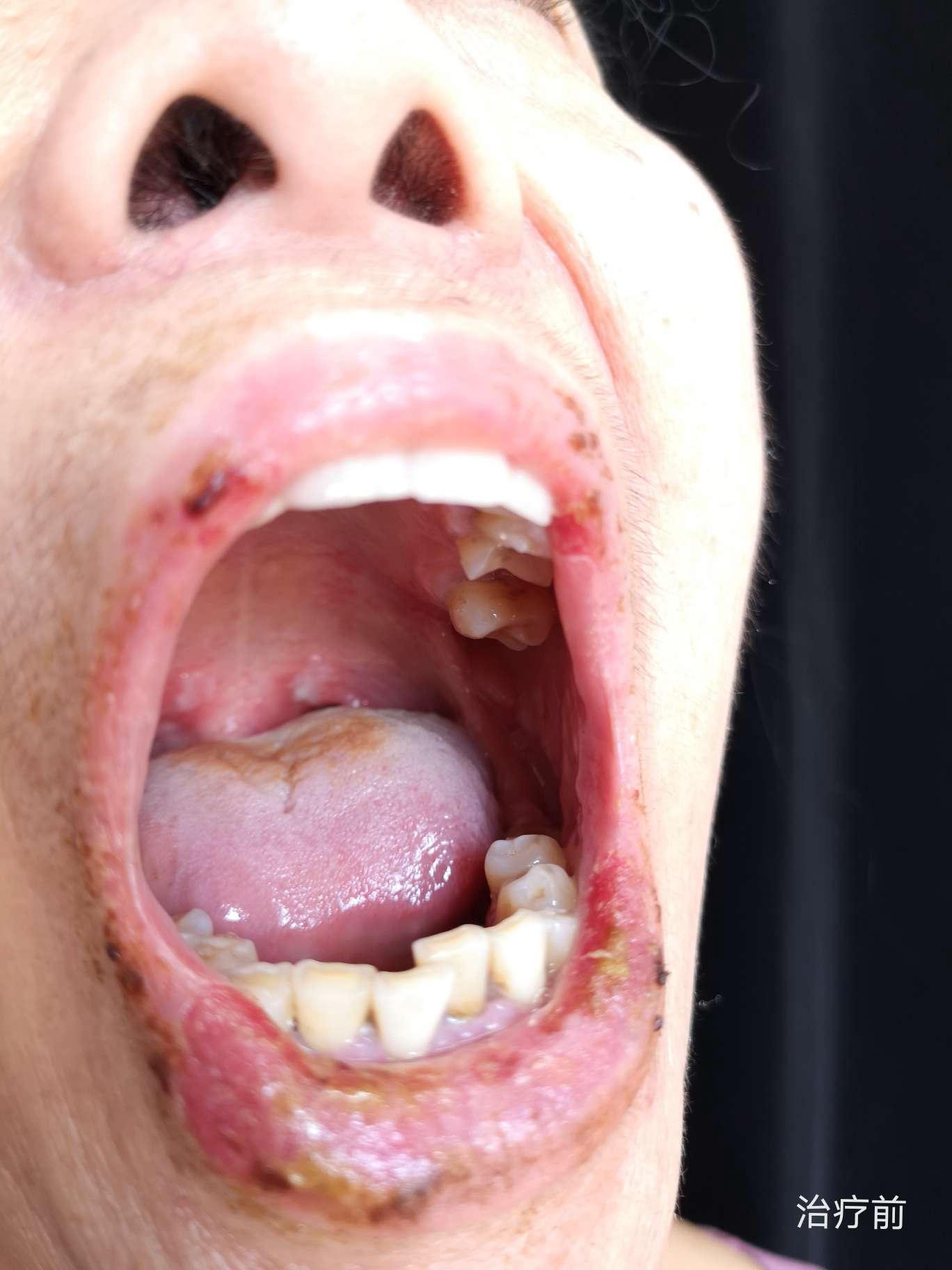 65岁患者口腔黏膜部位的天疱疮的诊断与治疗