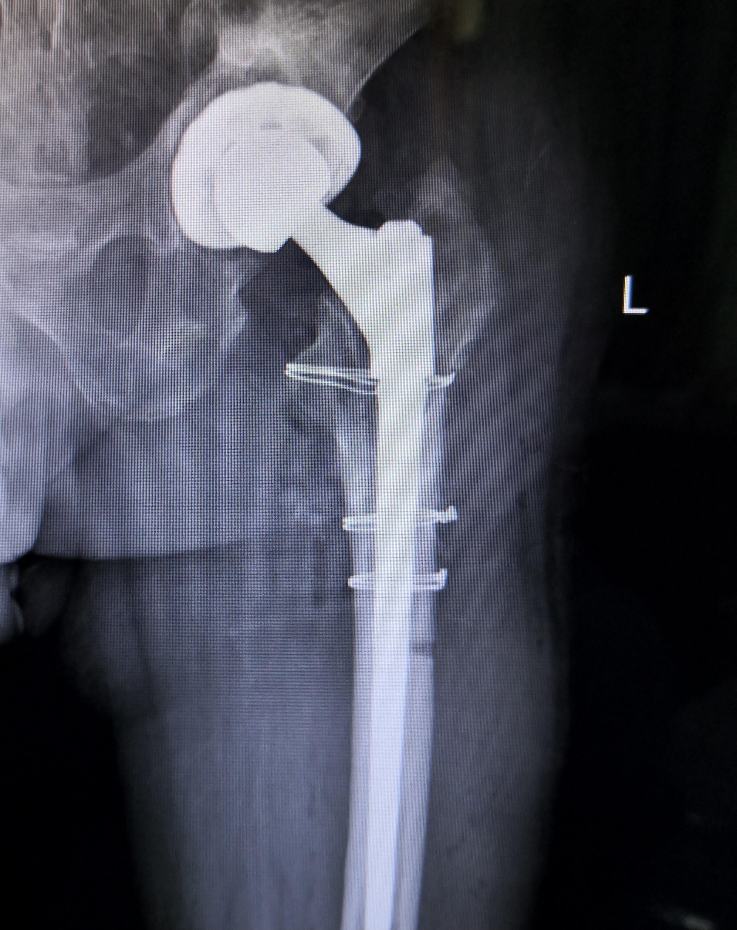 左髋关节置换术后假体松动翻修手术分享