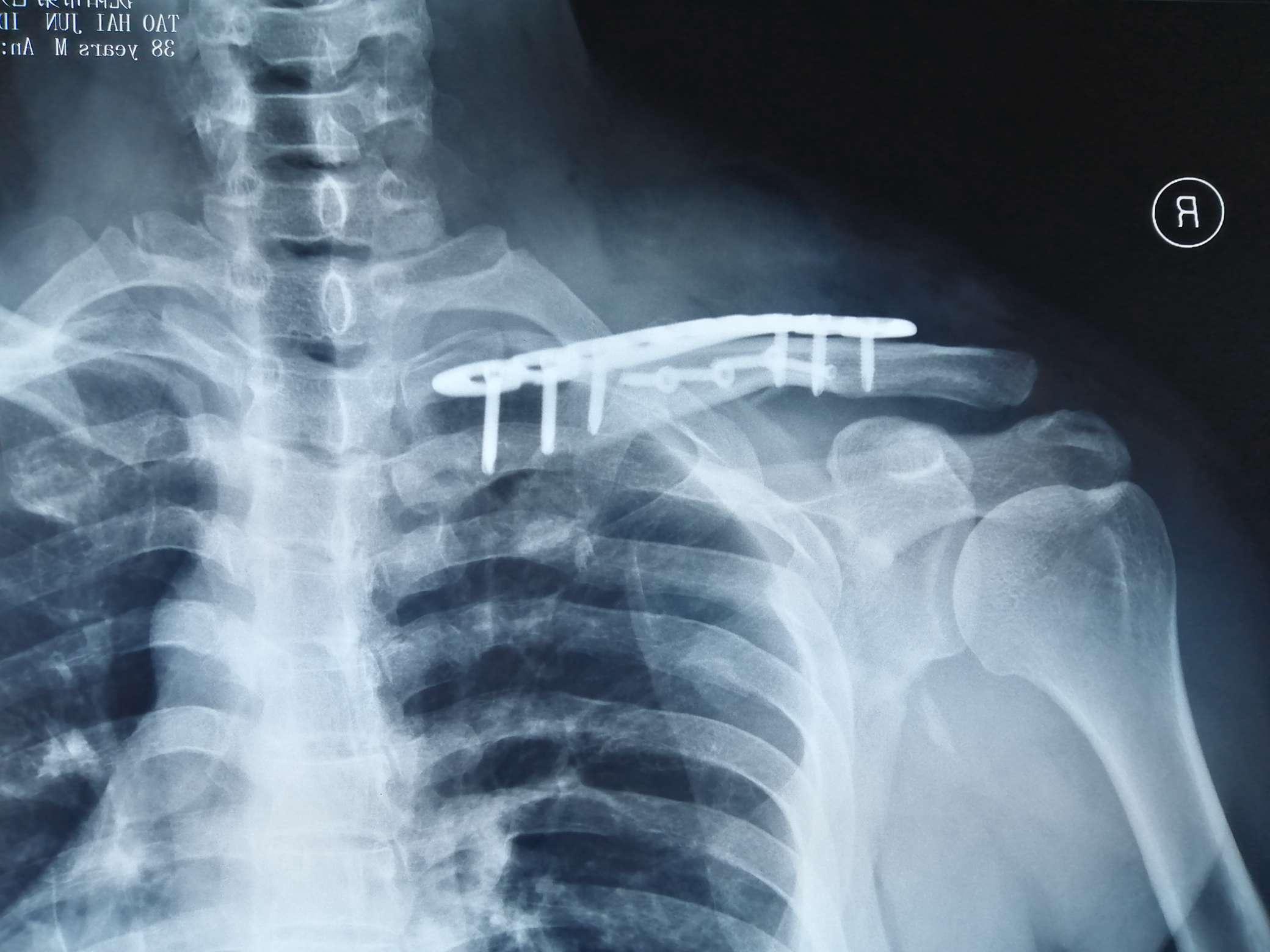 基础必学：肩锁关节脱位诊治要点及常用技术！