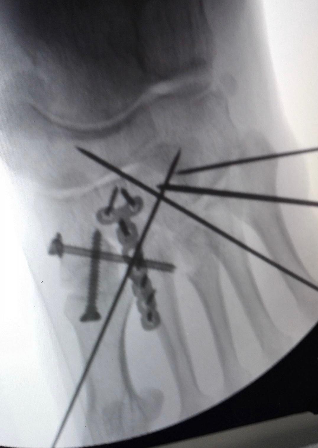 复杂跖跗关节骨折脱位手术分享