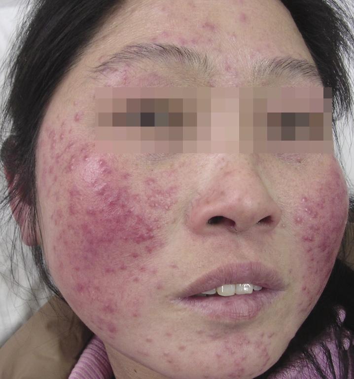 皮肤性病科图谱细菌性皮肤病皮肤结核