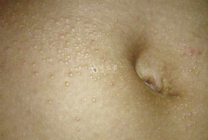 皮肤性病科图谱: 丘疹鳞屑性皮肤病 光泽苔藓