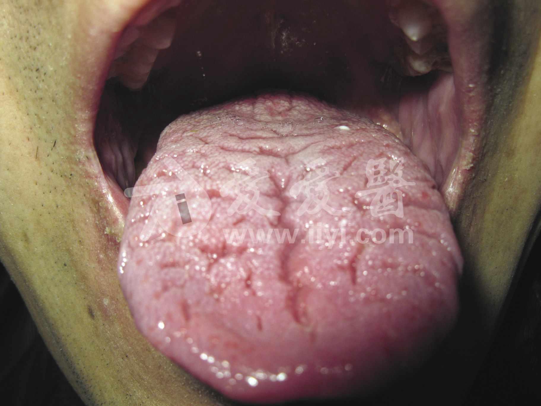 皮肤性病科图谱 黏膜疾病 皱襞舌