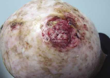 皮肤性病科图谱: 皮肤肿瘤 鳞状细胞癌