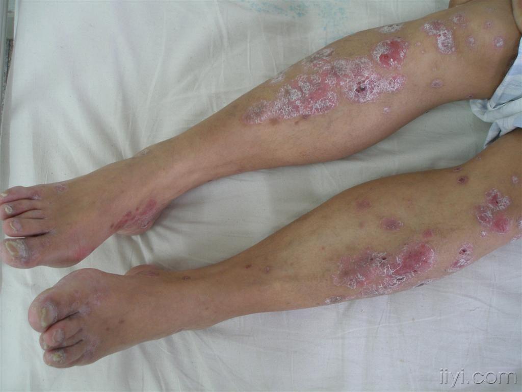 梅毒腿部图片图片