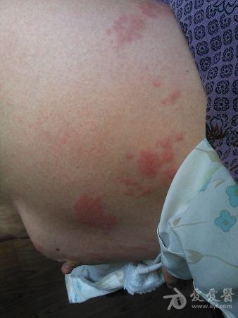 带状性疱疹初期症状图片