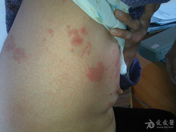 一例典型带状疱疹