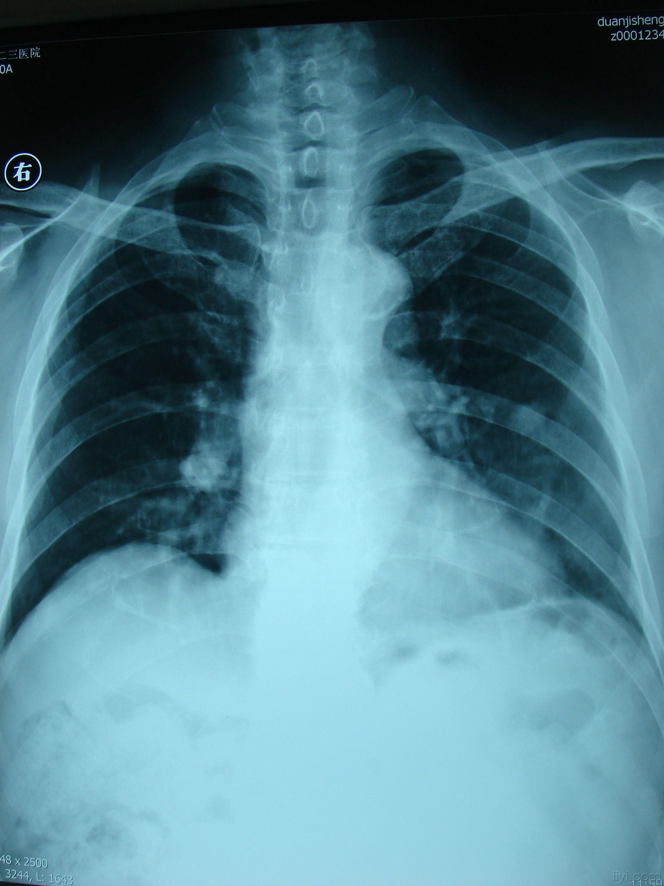 肺癌图片胸片图片