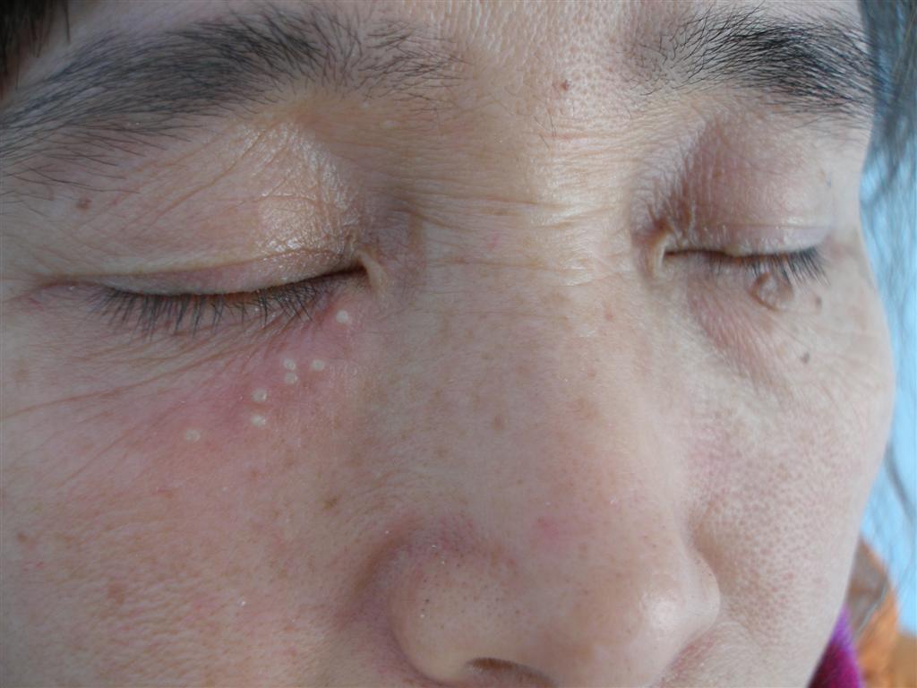 图示病例单纯疱疹