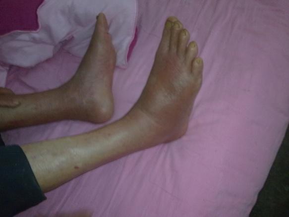 男,60岁,汉族,双小腿,足部红肿热痛10多天是否为蜂窝织炎