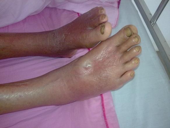 男,60岁,汉族,双小腿,足部红肿热痛10多天是否为蜂窝织炎