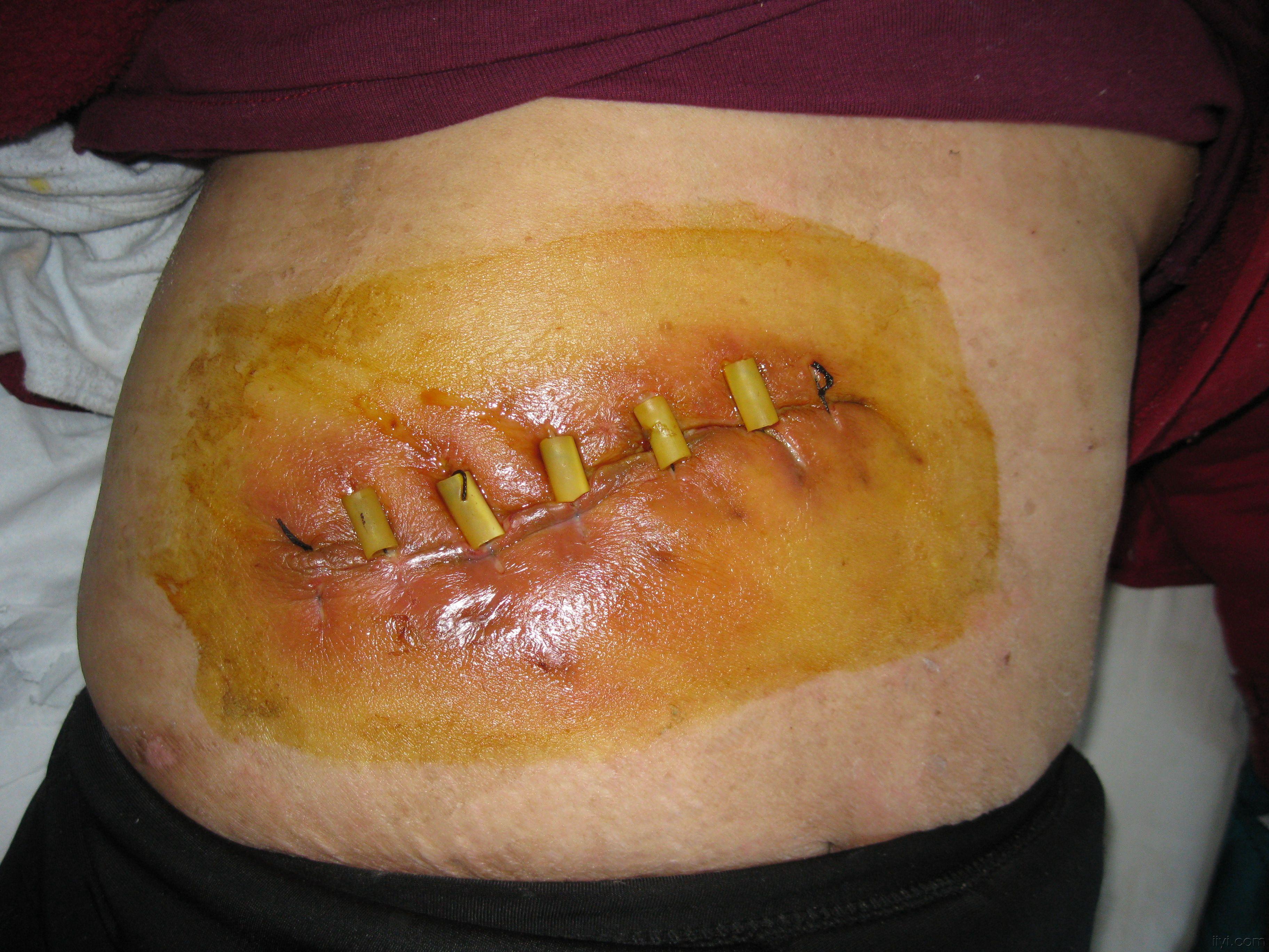 胆囊炎手术刀口图片图片