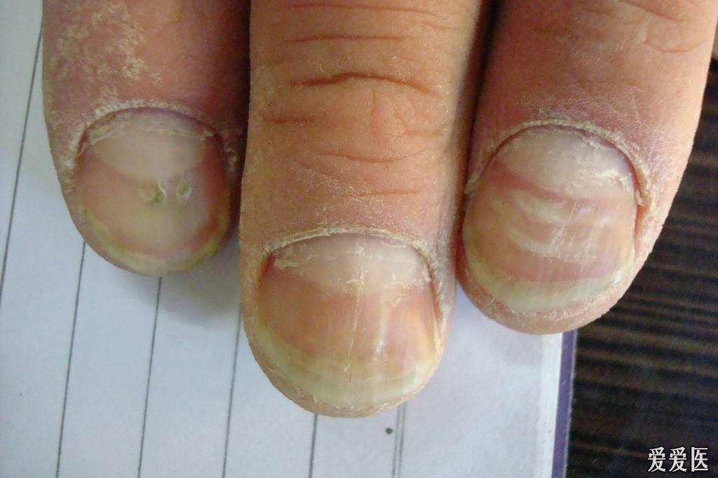 湿疹指甲演变过程图图片