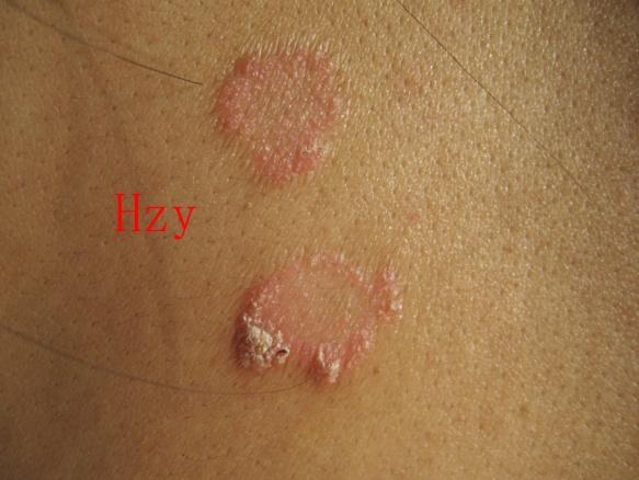 看看她背上的皮损