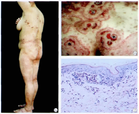 表现为环形红斑水疱的疱疹样皮炎