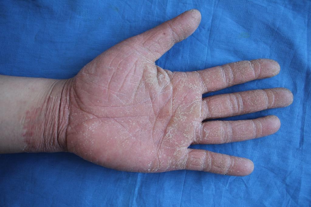 手癣初期症状图片图片