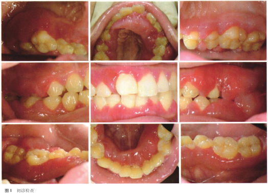 牙周炎症状图片 对比图片