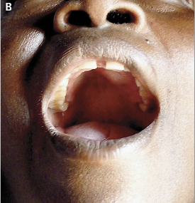 咽梅毒图片