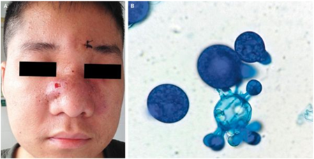 鼻面部虫霉病1例