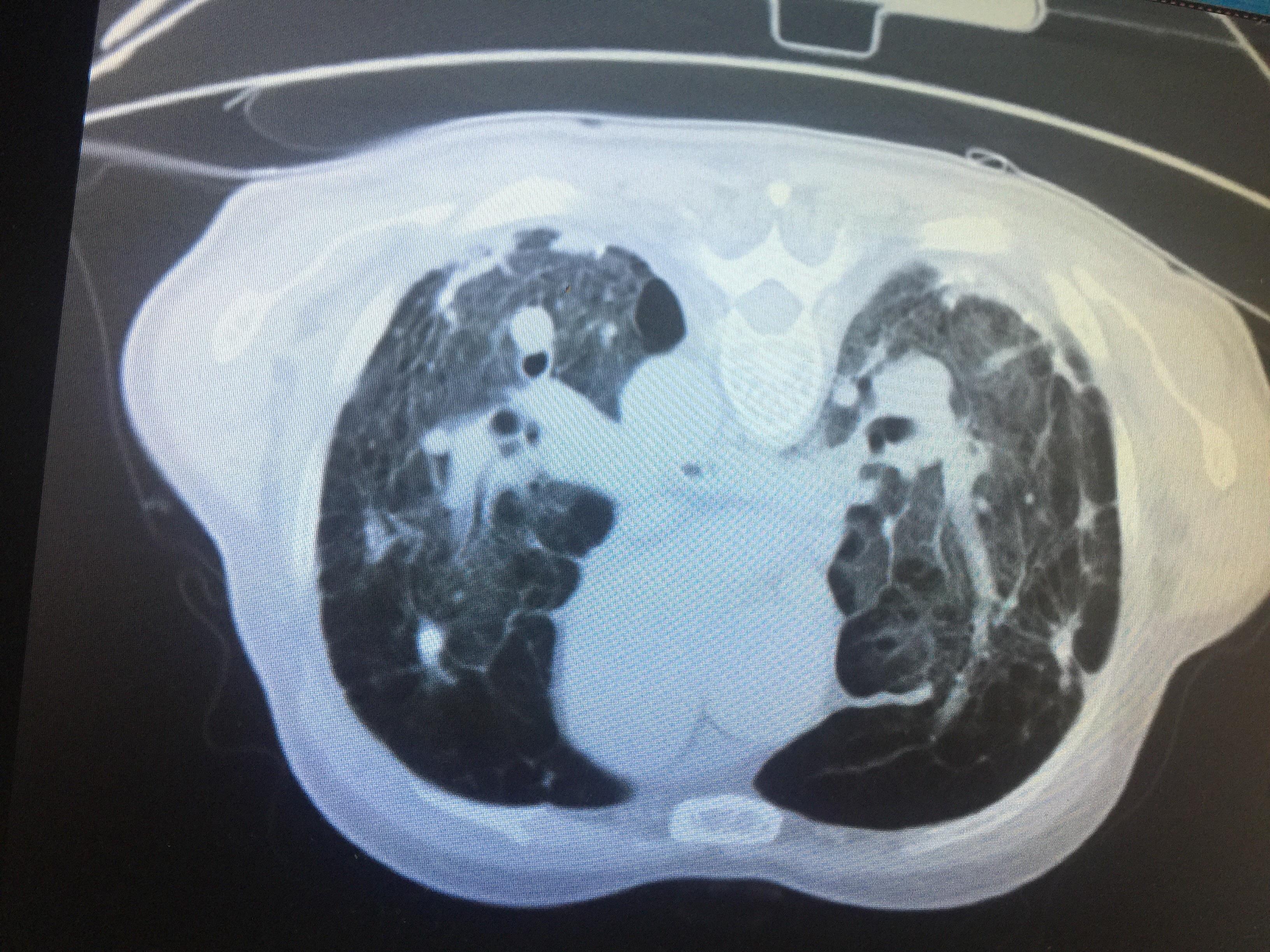肺部 CT 阅片技巧剖析 障眼法再也不怕了 - 丁香园