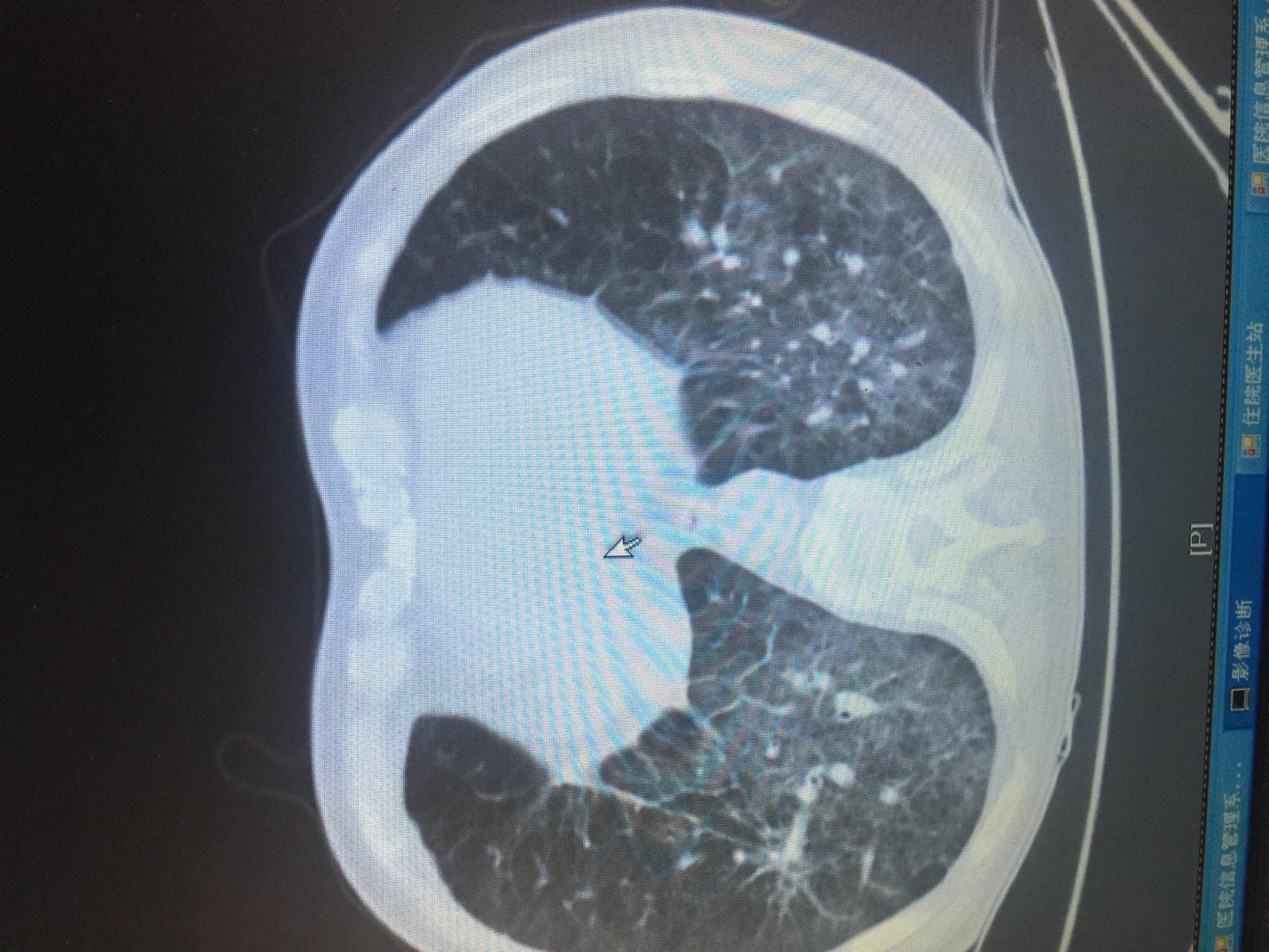 经典肺CT 展示 - 呼吸内科专业讨论版 - 爱爱医医学论坛