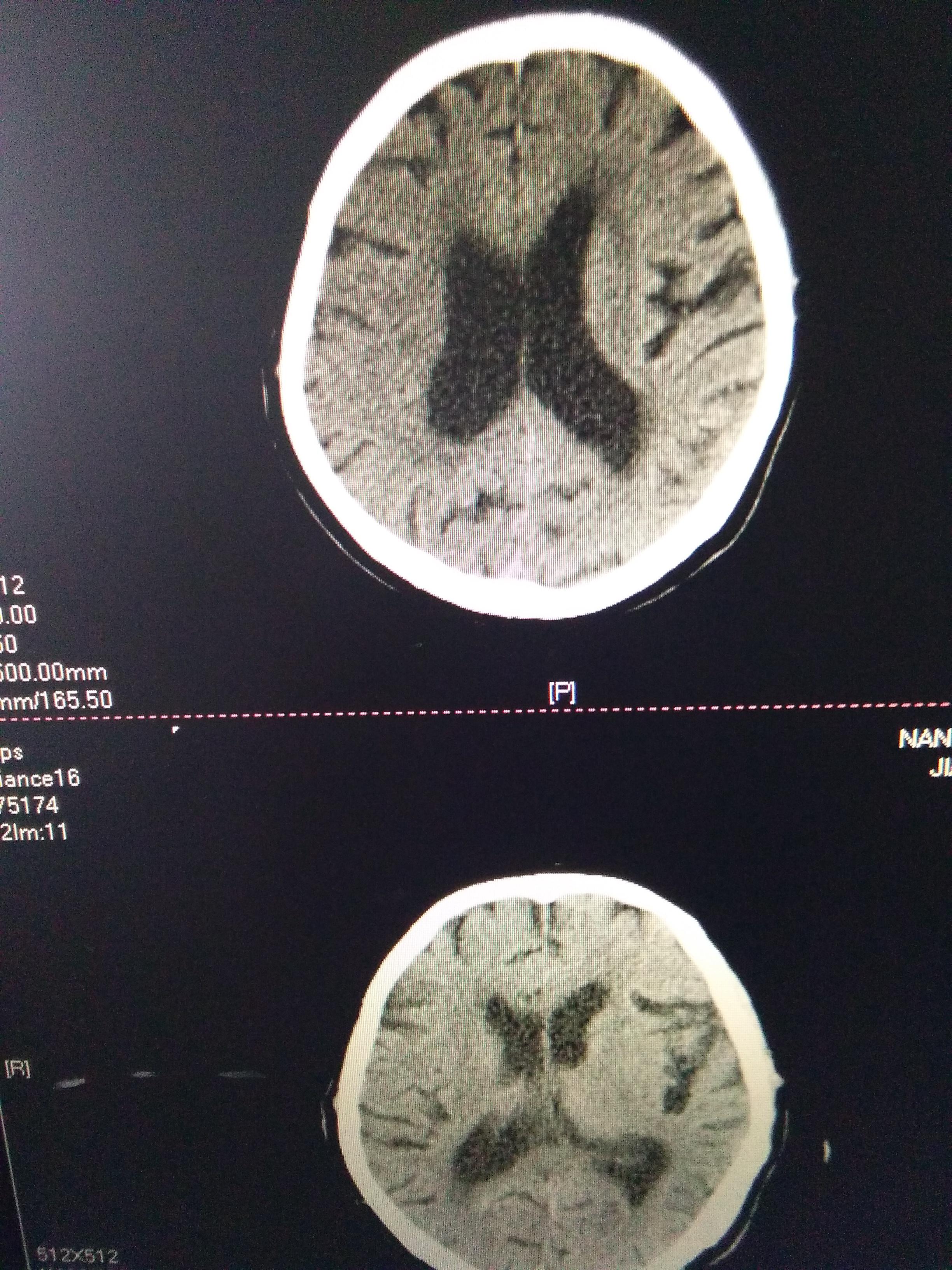 脑供血不足的人，头部若出现4种表现，多半是脑梗，劝你早查脑CT|脑供血不足|脑CT|头部_新浪新闻