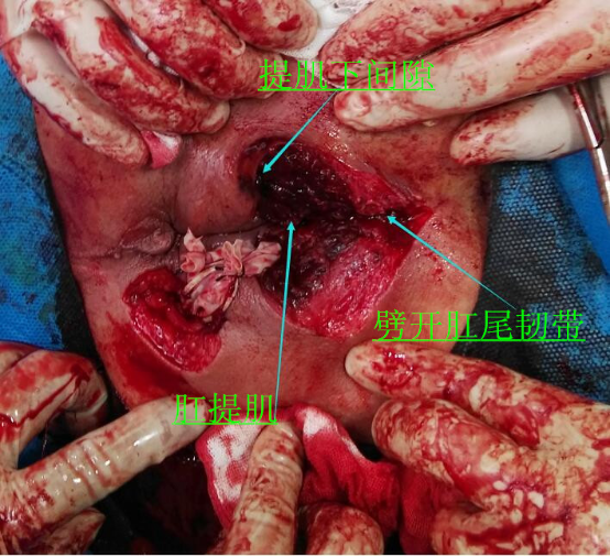 肛周脓肿术后刀口图片图片