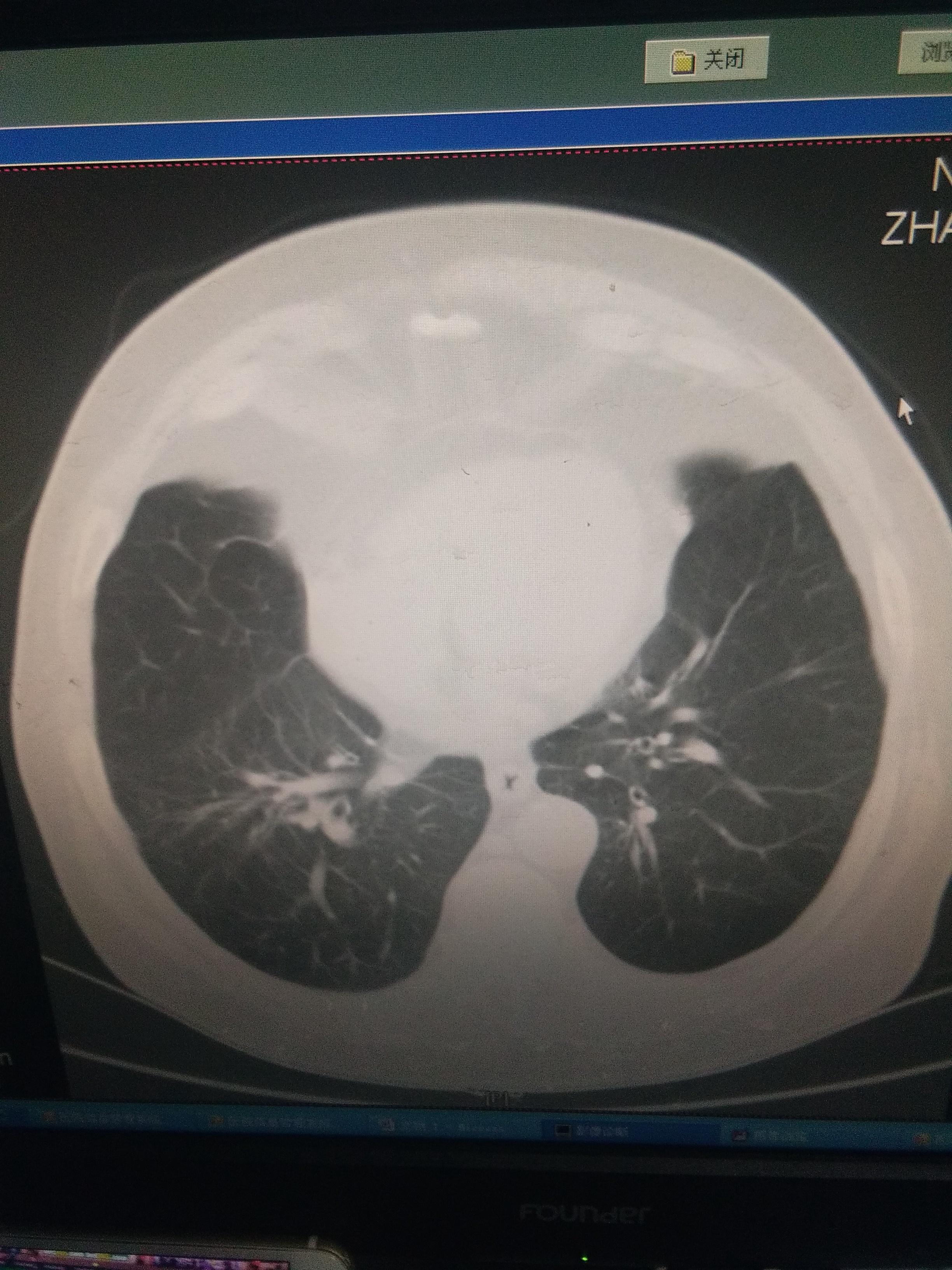 肺癌ct影像表现特点,正常肺ct - 伤感说说吧