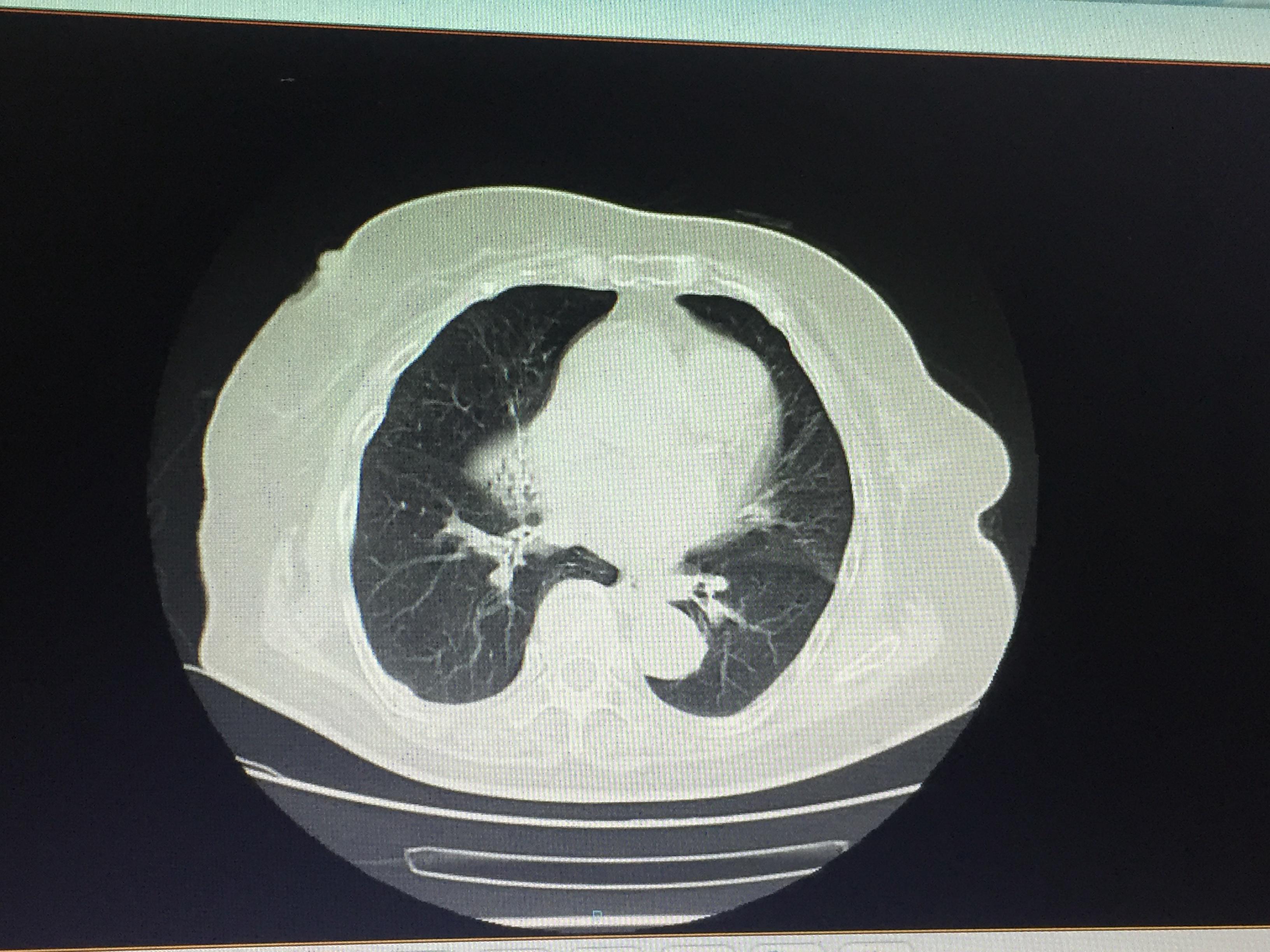 第二节 慢性肺源性心脏病-临床疾病心电图-医学