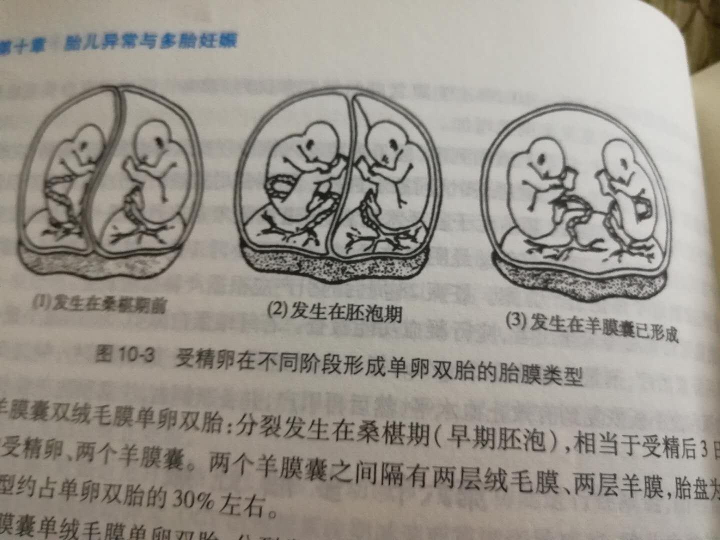 双胞胎与单胎症状大有不同，孕妈教你看懂这5个暗示(图2)