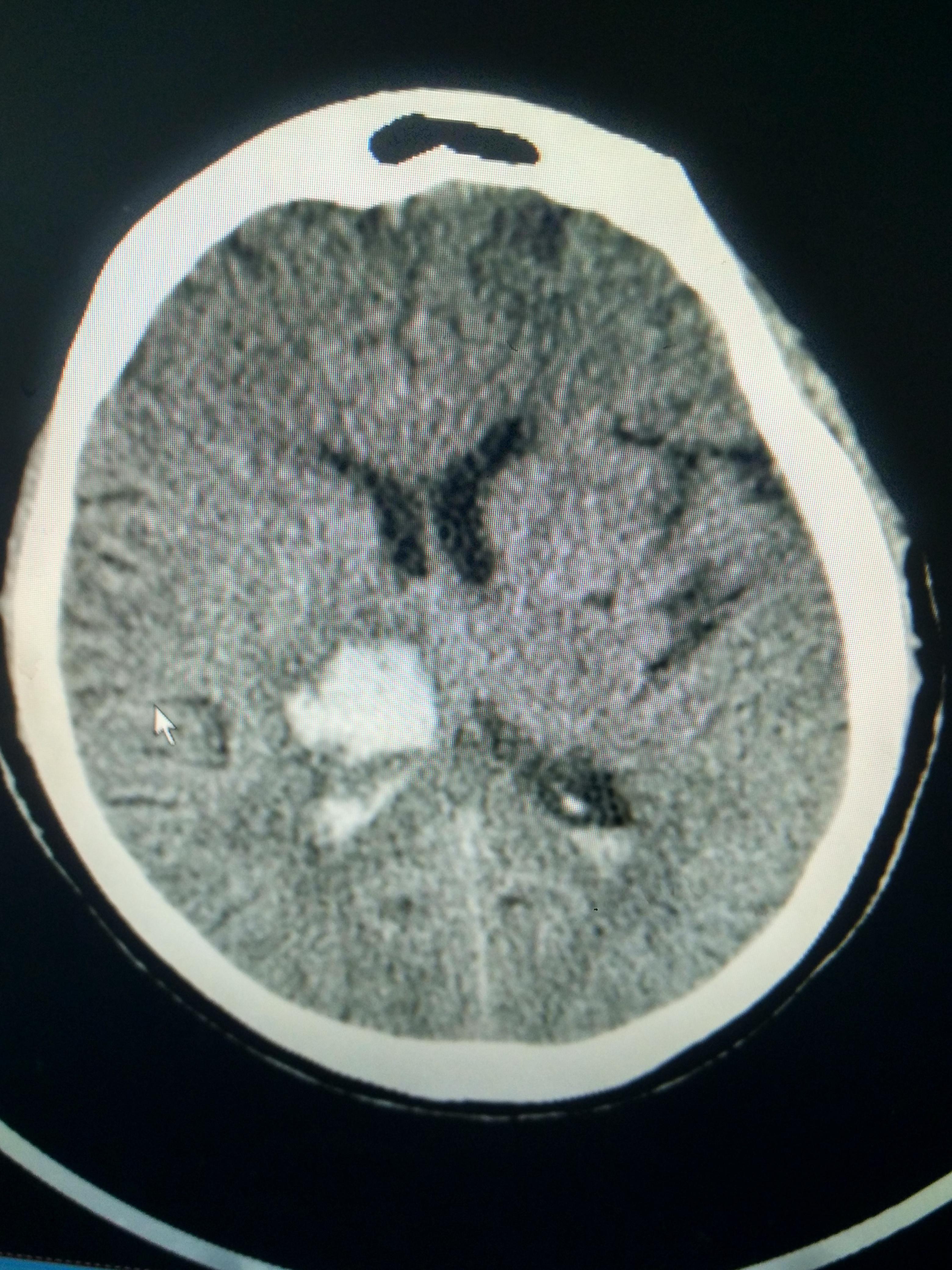 头颅 MR、CT 临床实用「影像征」（一） - 脑医汇 - 神外资讯 - 神介资讯