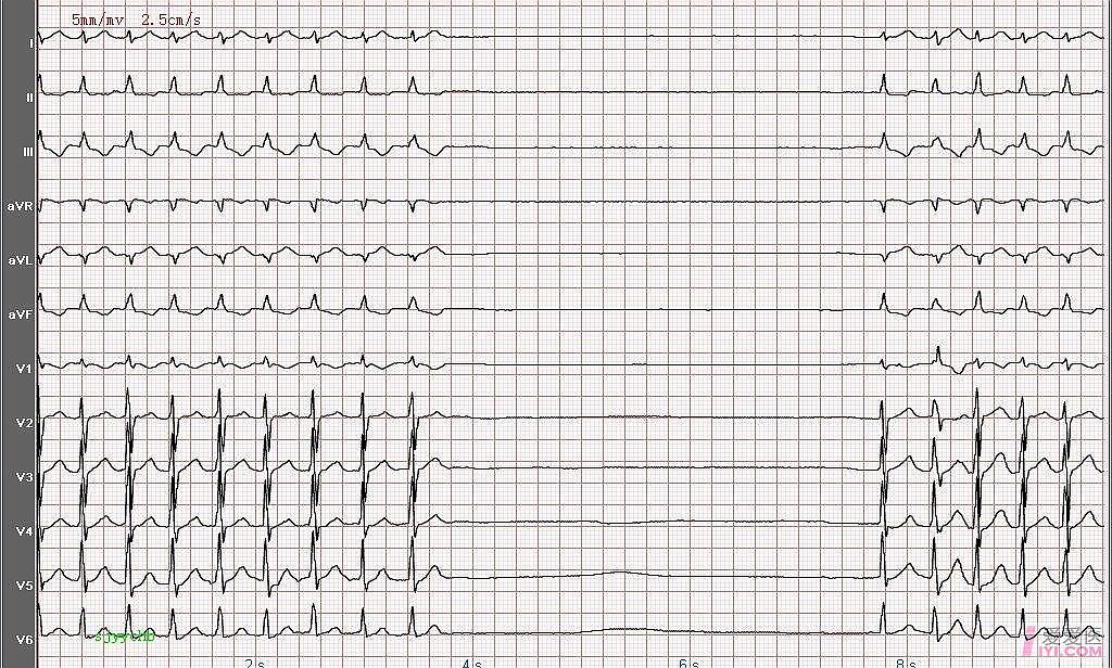 心电图图例分析：病窦综合征－较久性全心停搏
