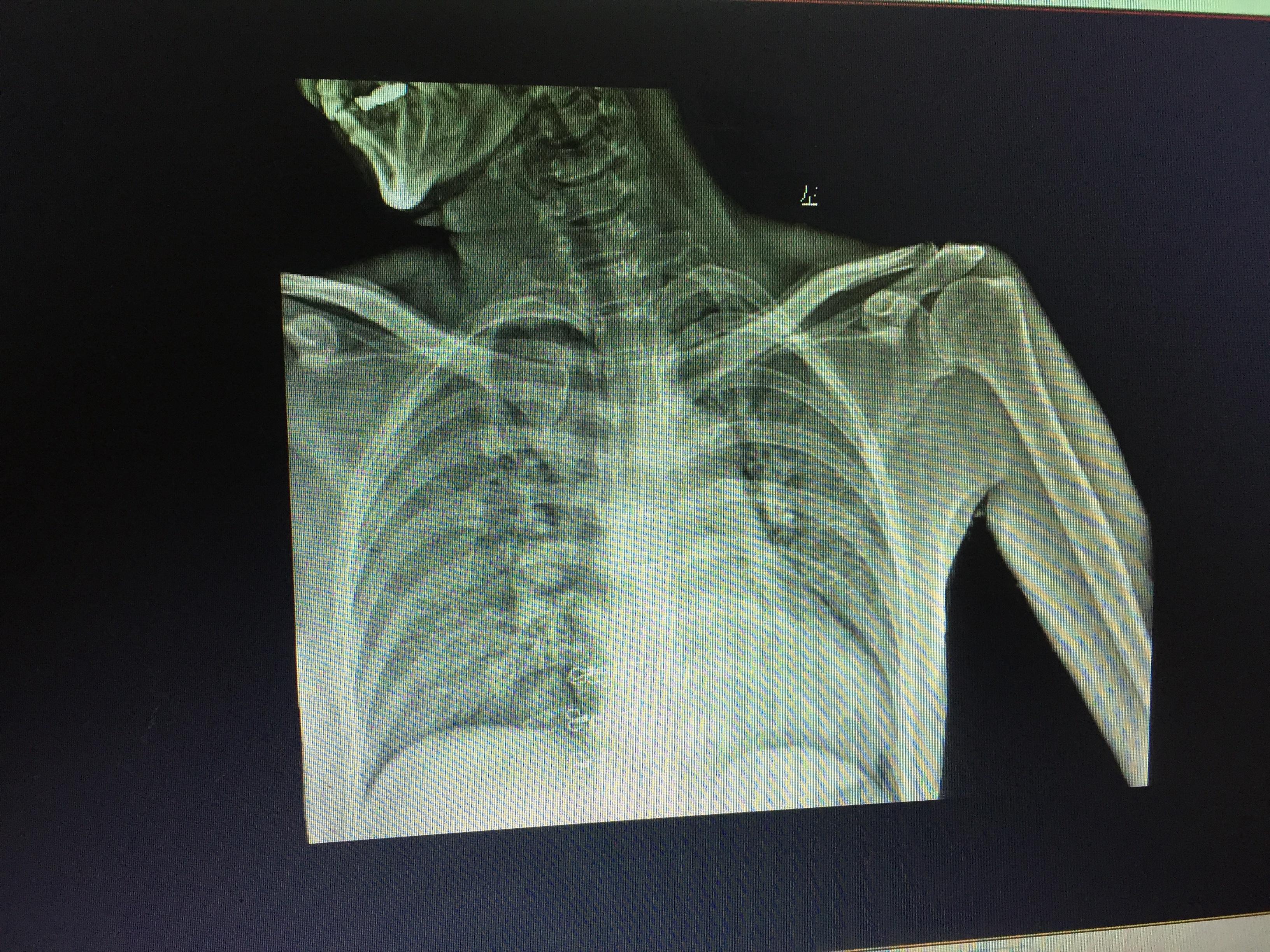 左侧肩胛骨骨折一例