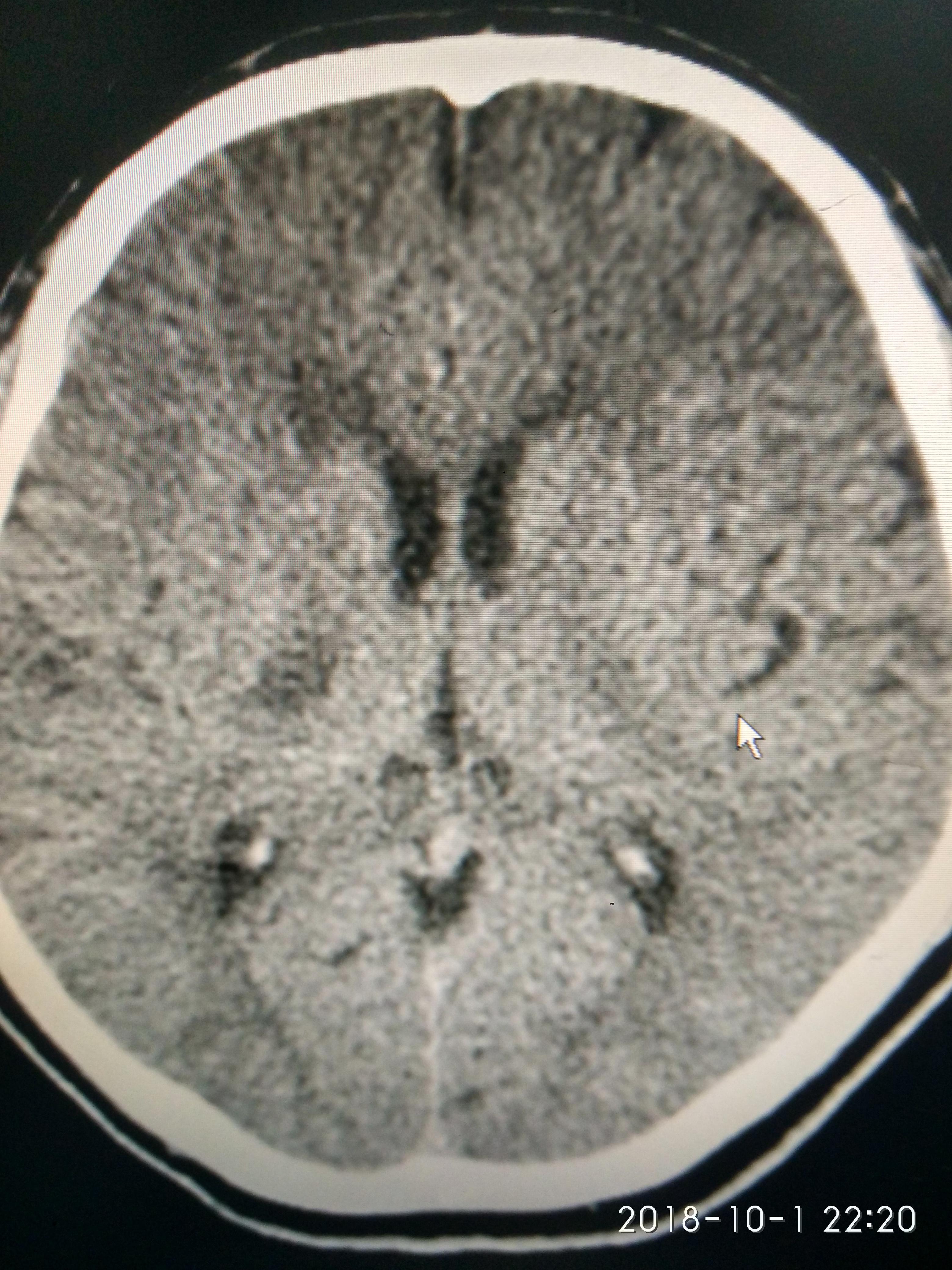 脑血管影像案例（38）：心脏室壁瘤伴血栓形成所致栓塞性脑梗死 - 脑医汇 - 神外资讯 - 神介资讯
