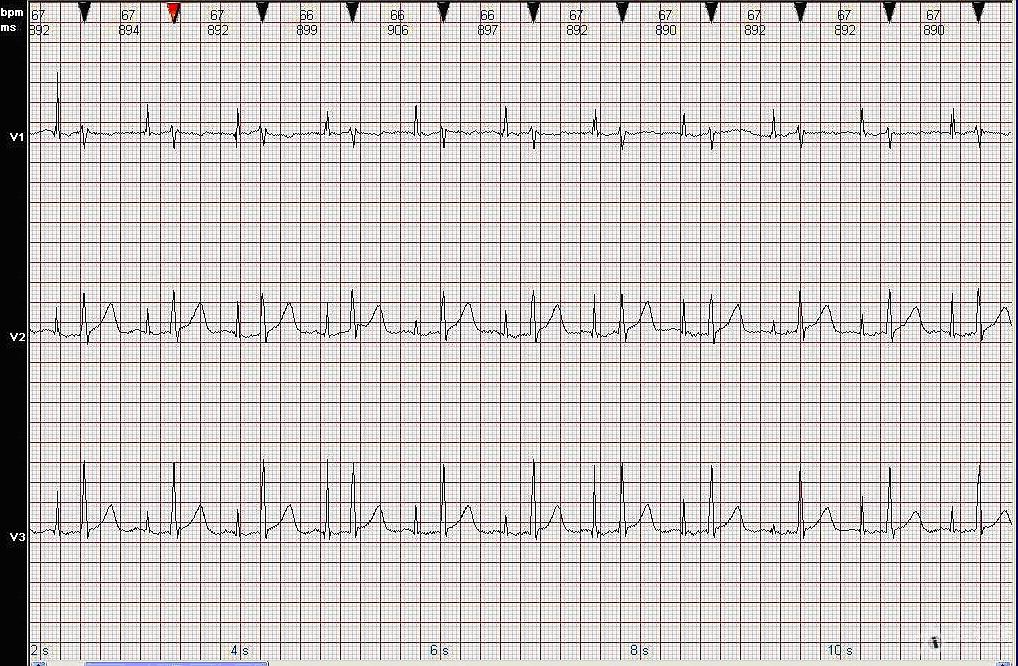 心电图图例分析：心房起搏心律AAI模式