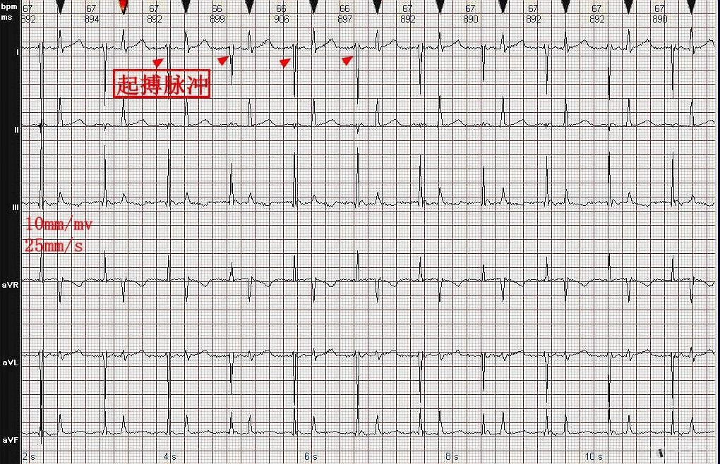 心电图图例分析：心房起搏心律AAI模式