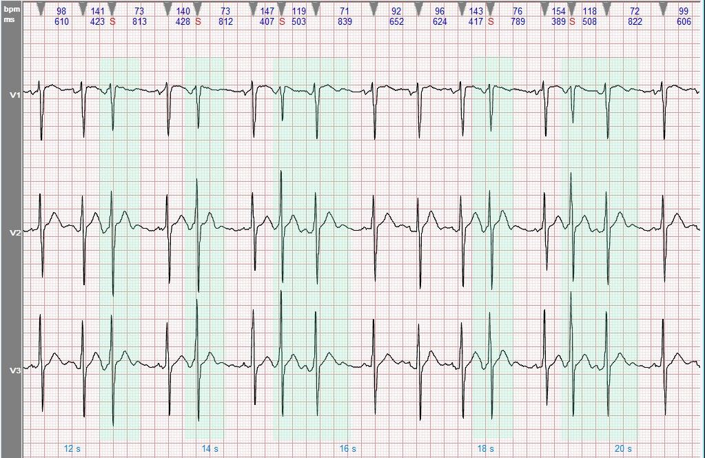 心电图图例分析：频发交界性早搏，部分呈连发