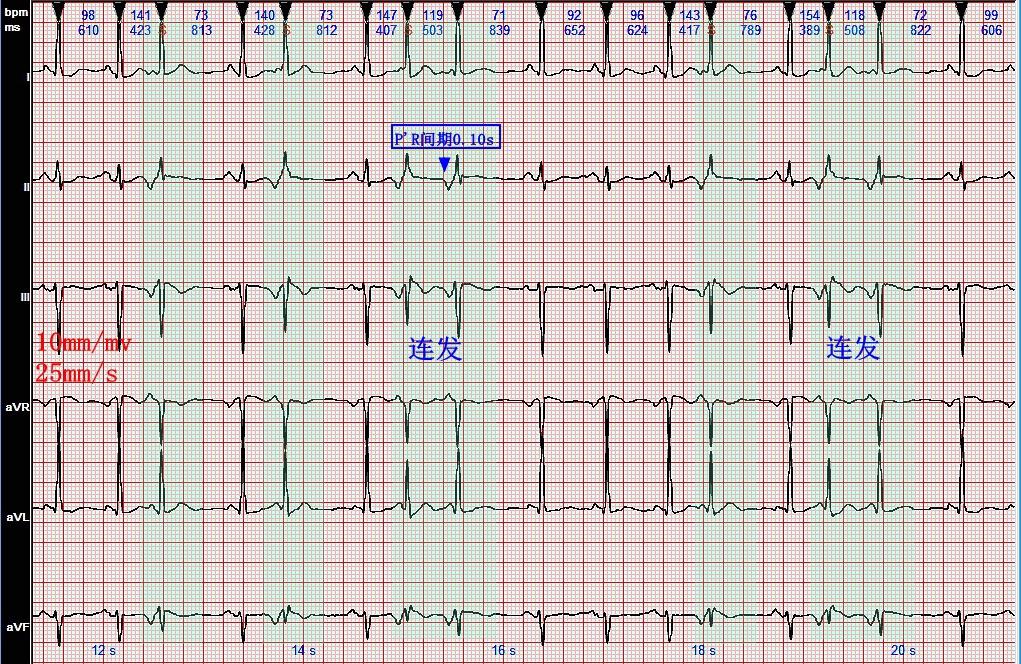心电图图例分析：频发交界性早搏，部分呈连发