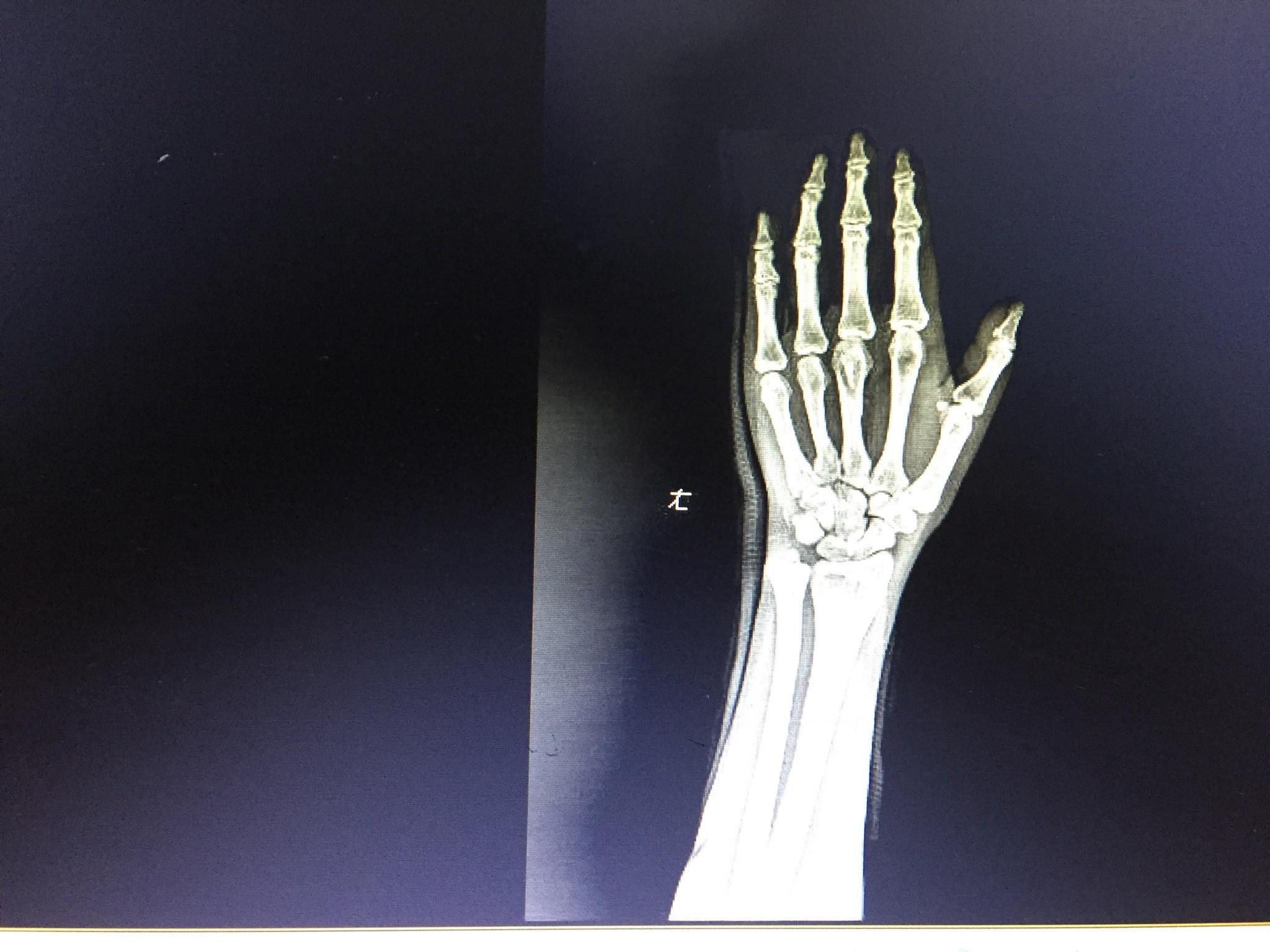 右手第四掌骨斜行性骨折，拍X片图（图片在百度相册）。寻求好的治疗方案。明天用，较急 急_百度知道