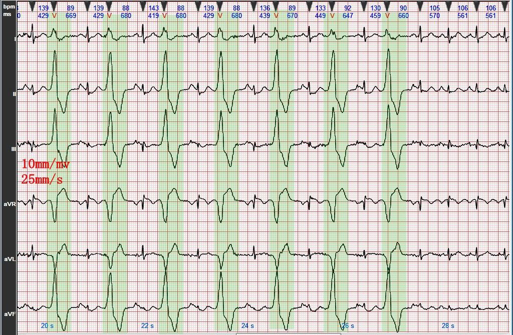心电图图例分析:室性早搏呈二联律(1)