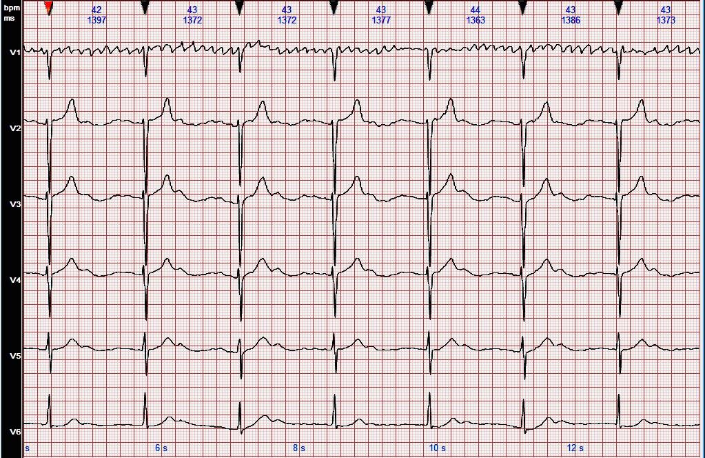 心电图图例分析:心房颤动,三度房室传导阻滞,交界性(1)