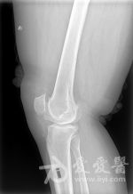 膝盖滑膜炎怎么治好 5bf6567e04ac6_w150.png