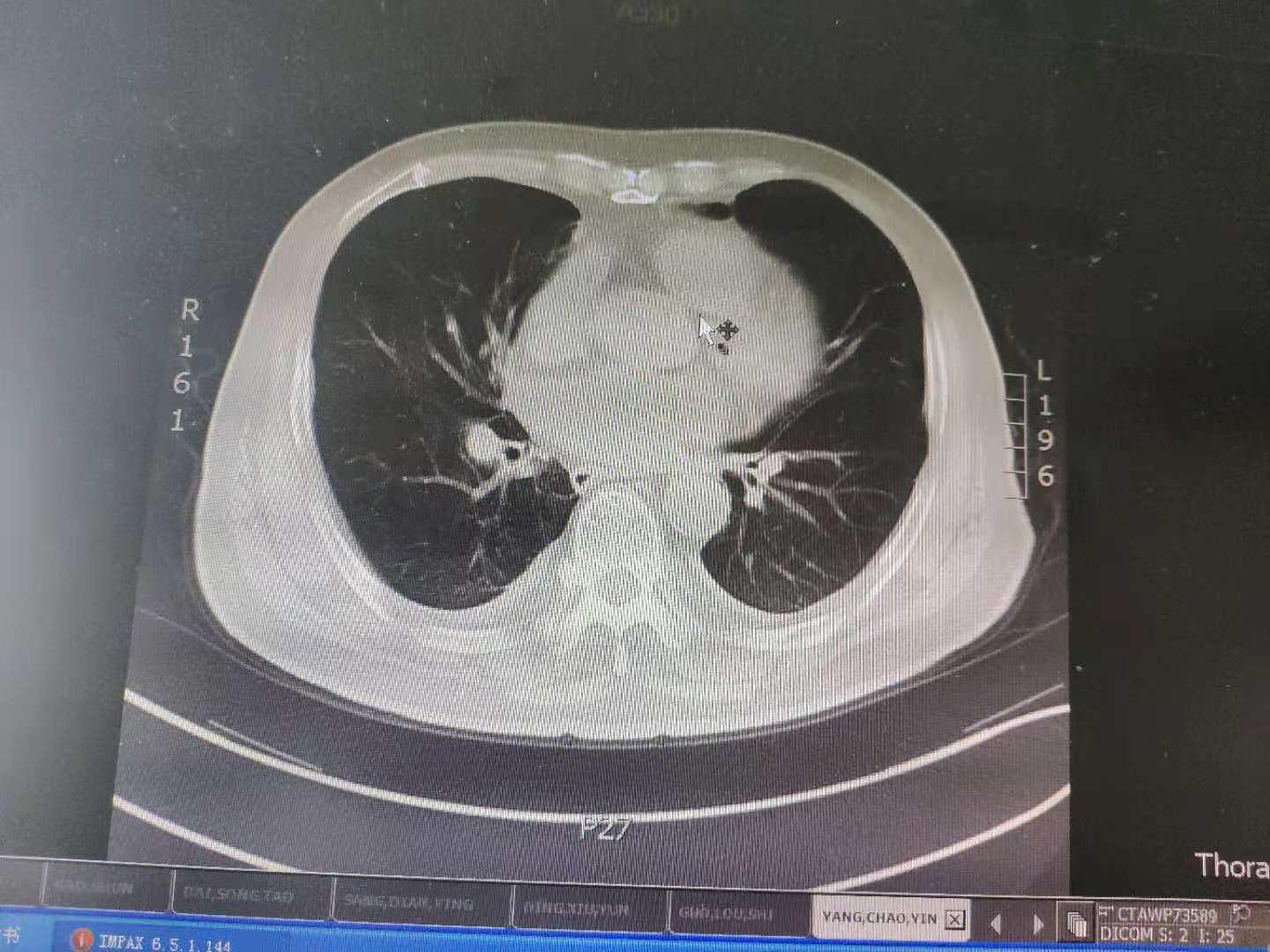 早期肺癌信号怎么查？医生说最好定期做肺部CT检查 - 知乎