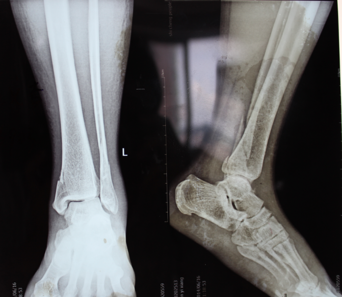 左侧外踝骨折 左侧腓骨骨折1例 病例中心 诊疗助手 爱爱医医学网