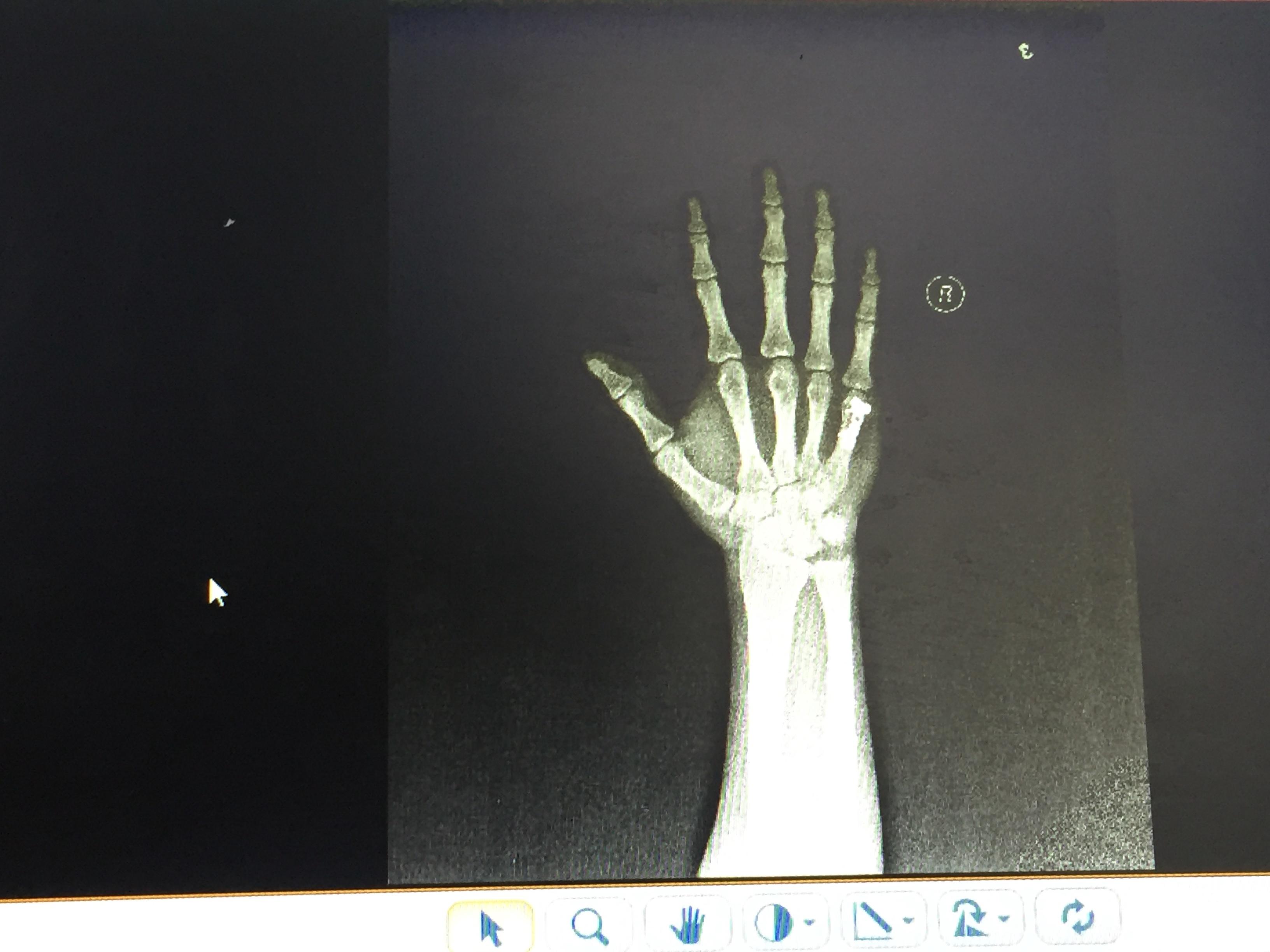 右手第一掌骨基底部骨折病例报告 - 病例中心(诊疗助手) - 爱爱医医学网